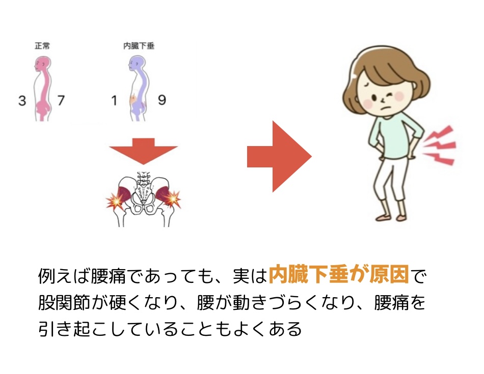 腰痛のイメージ
