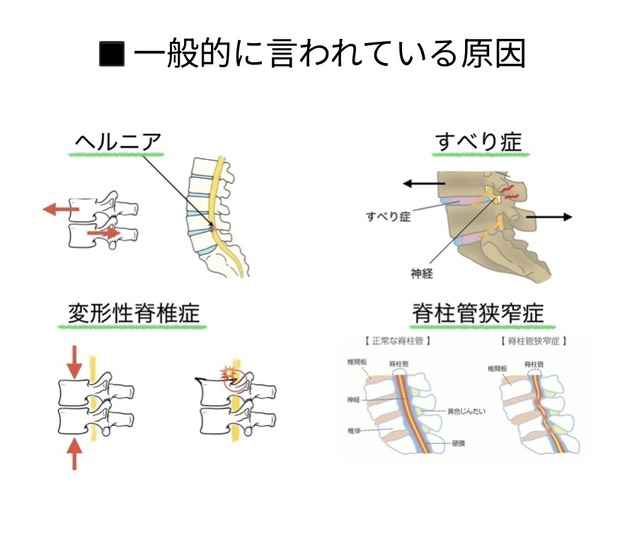 坐骨神経痛の原因イメージ
