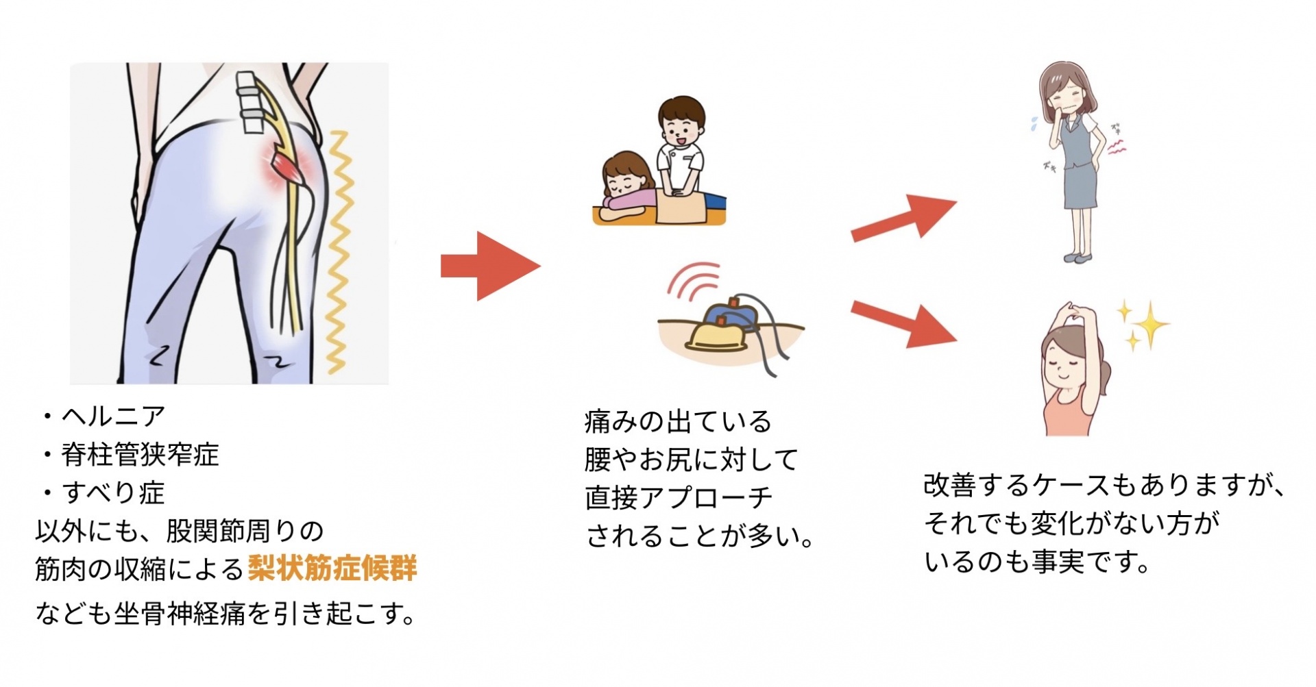 坐骨神経痛の原因イメージ